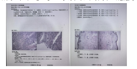 高难度颈部巨大鳞癌手术成功实施 酉阳县人民医再展医疗实力