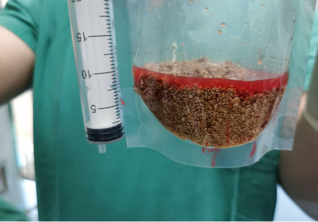我院完成一例巨大膀胱结石钬激光碎石取石术